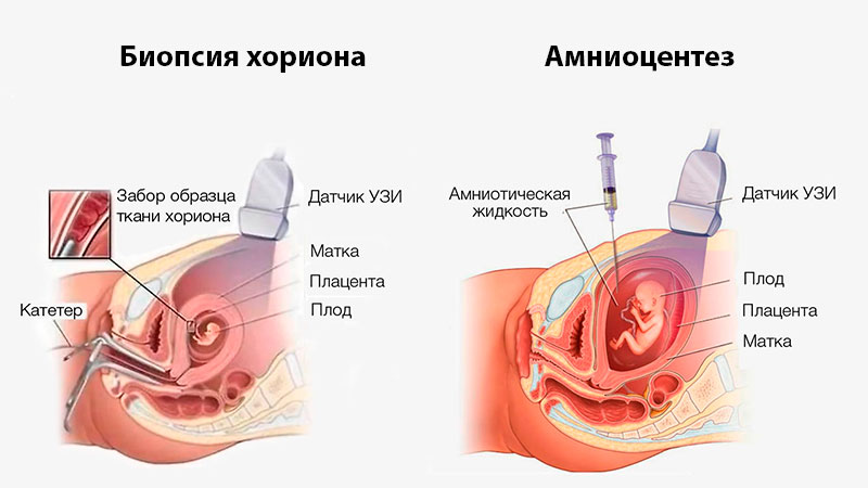 Амниоцентез и биопсия