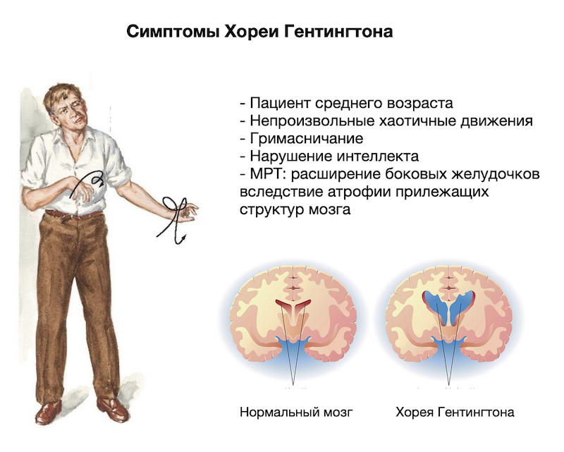 Хорея Гентингтона симптомы