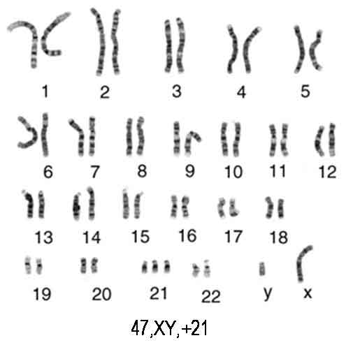 Кариотип синдрома Дауна